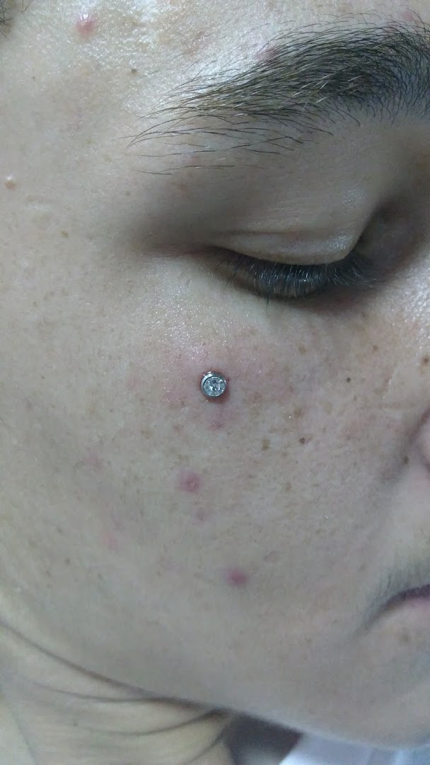 Close-up of a person's face with a new cheek piercing featuring a small, sparkling gem.